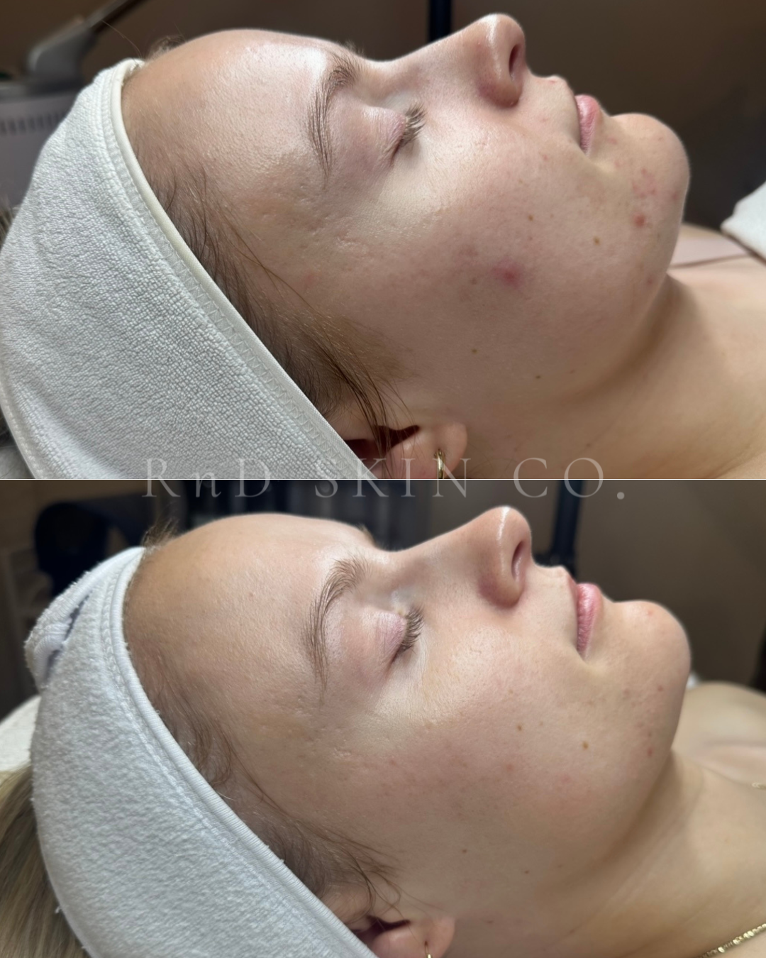 Acne + Pigmentation