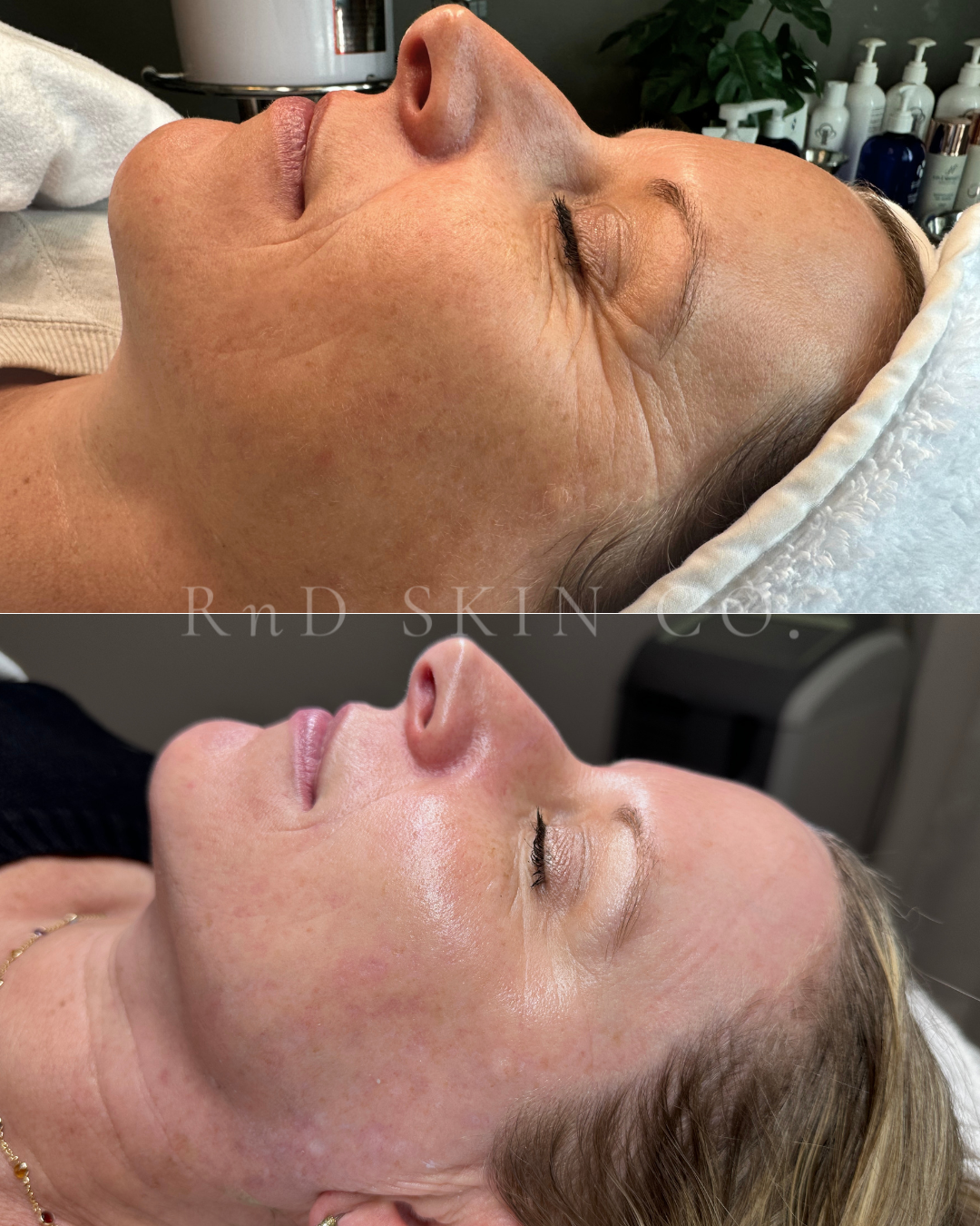 Pigmentation + Fine Lines