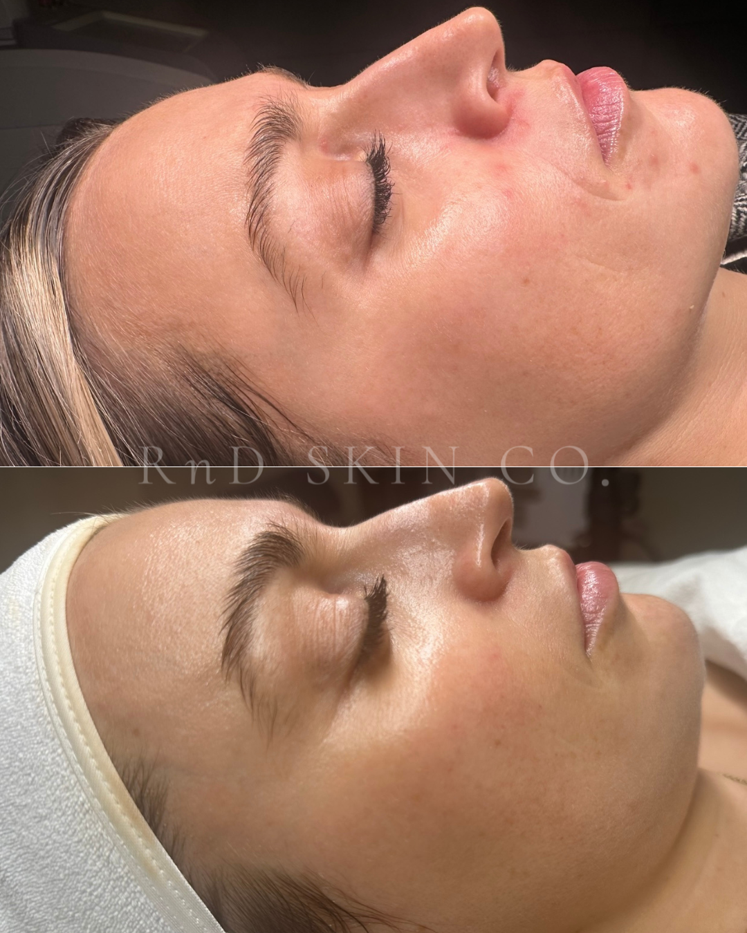 Pigmentation + Scaring + Fine Lines + Perioral Dermatitis