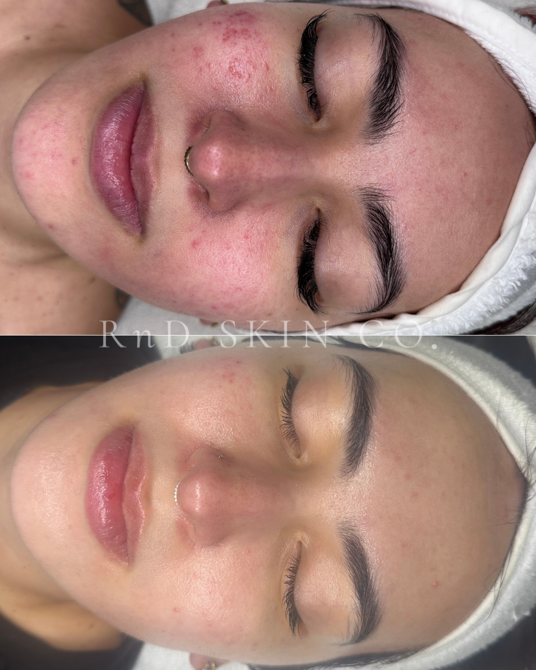 Acne + Pigmentation + Redness + Barrier