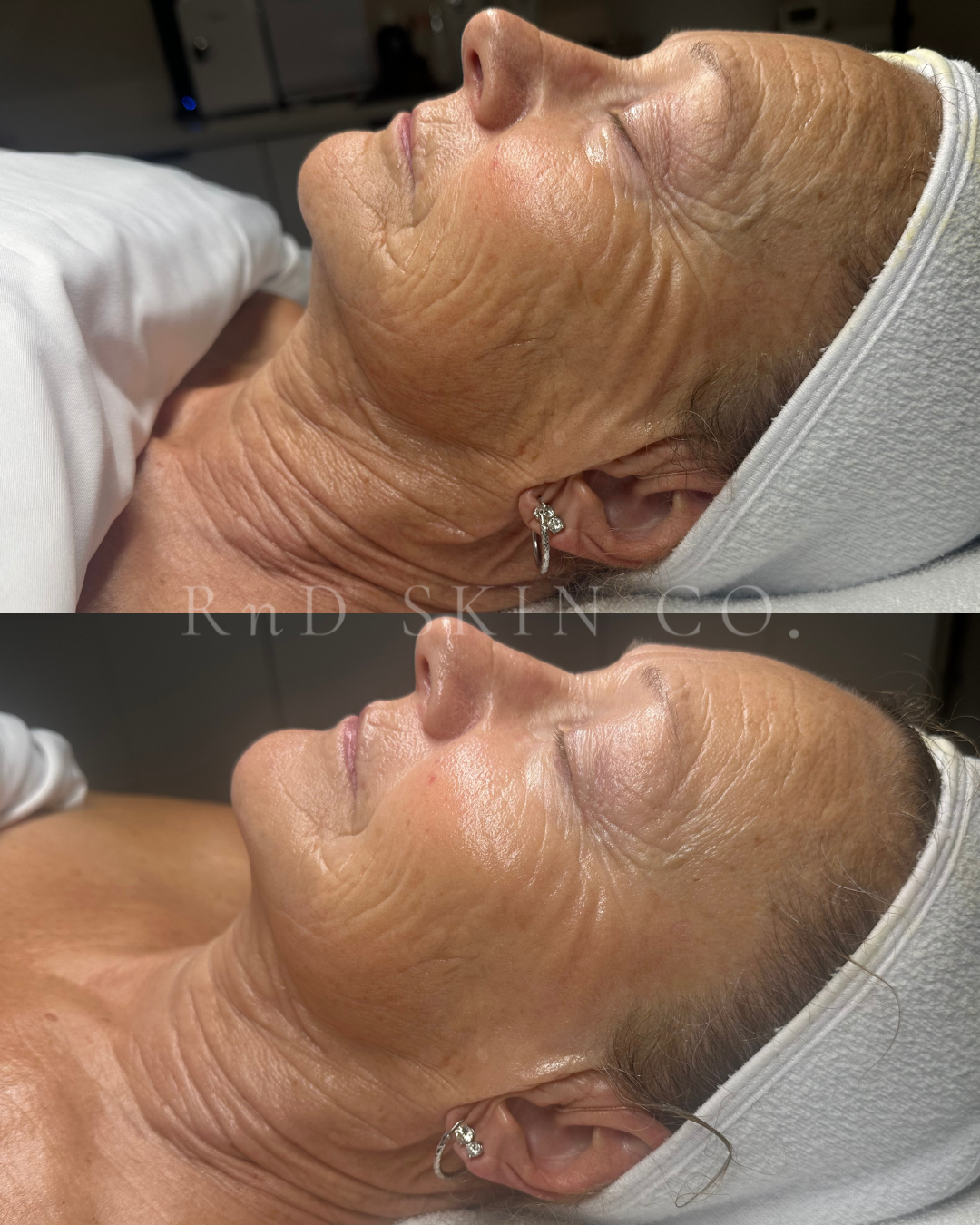 Fine Lines &amp; Wrinkles