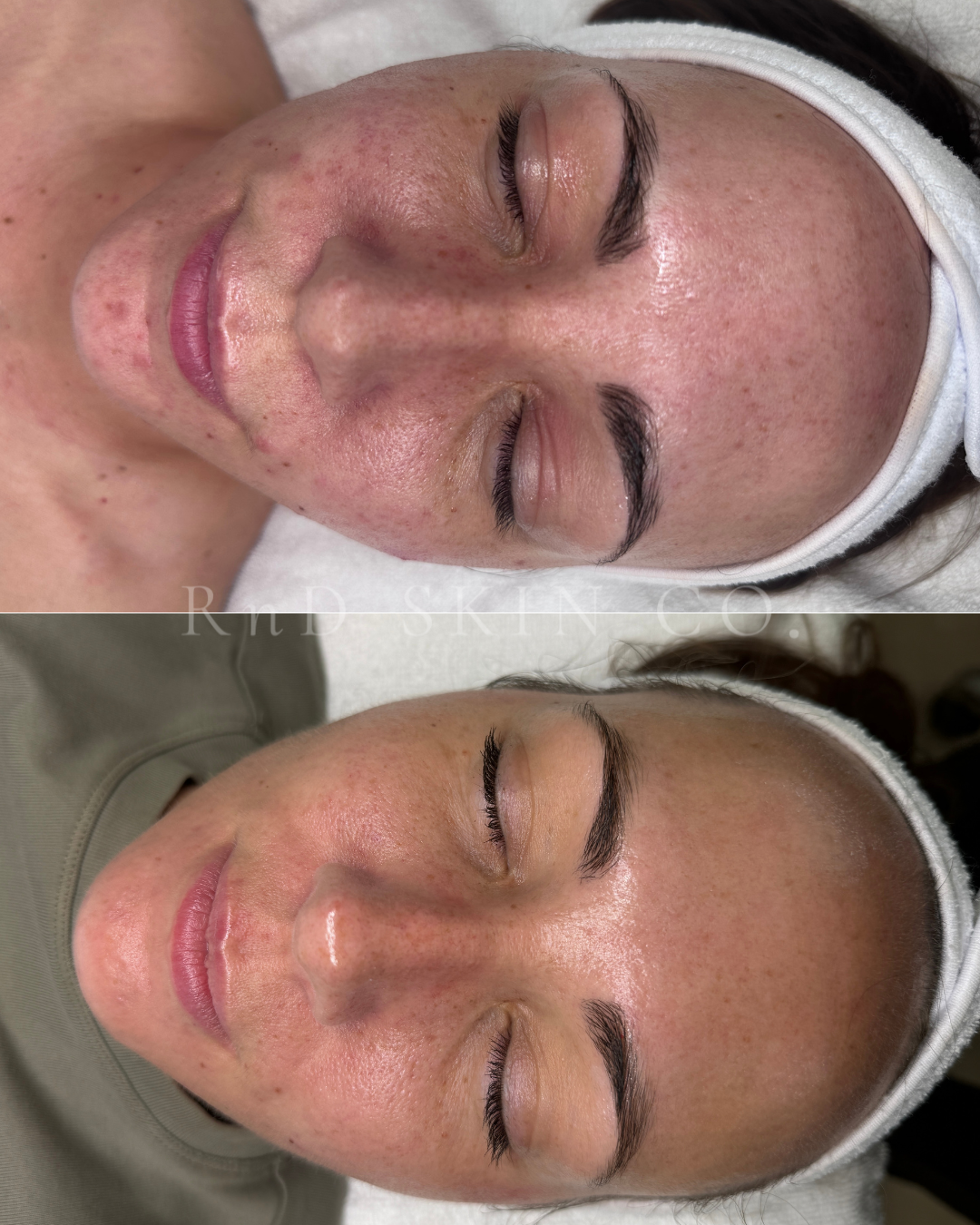Acne + Scaring + Pigmentation + Barrier