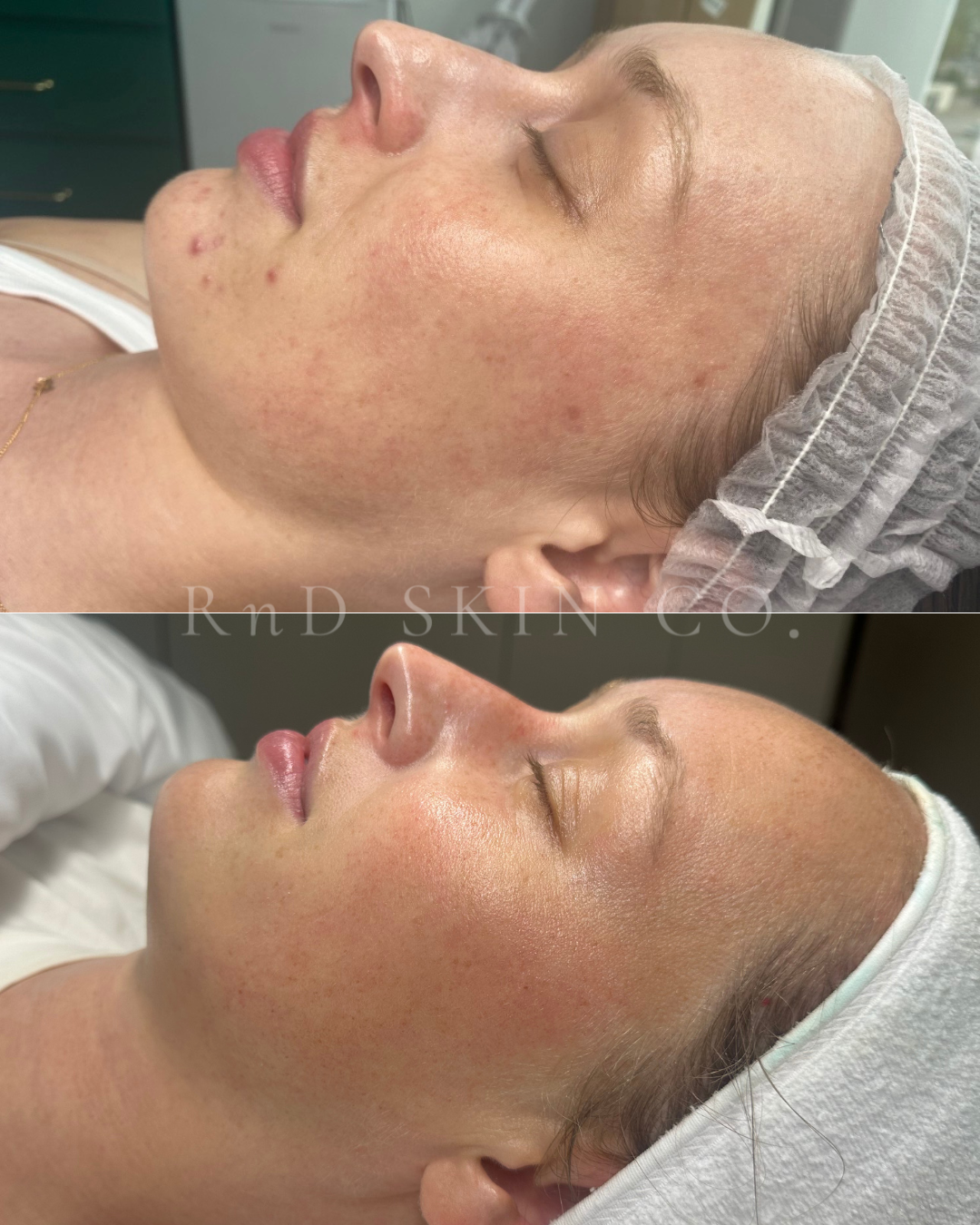 Acne + Tone + Barrier