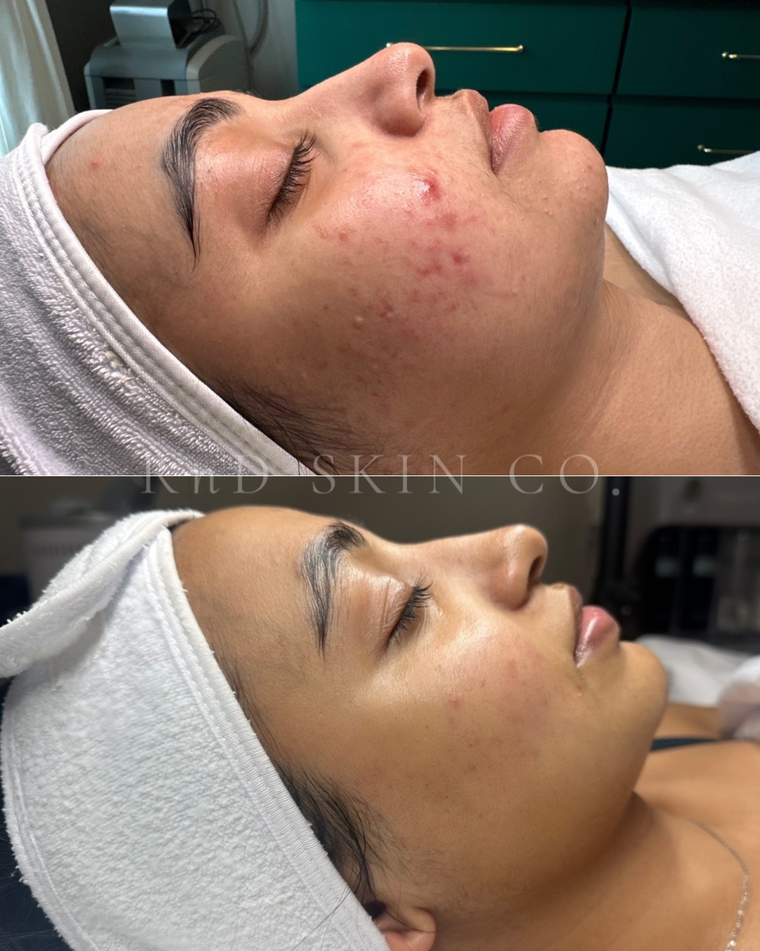 Acne + Scaring + Barrier