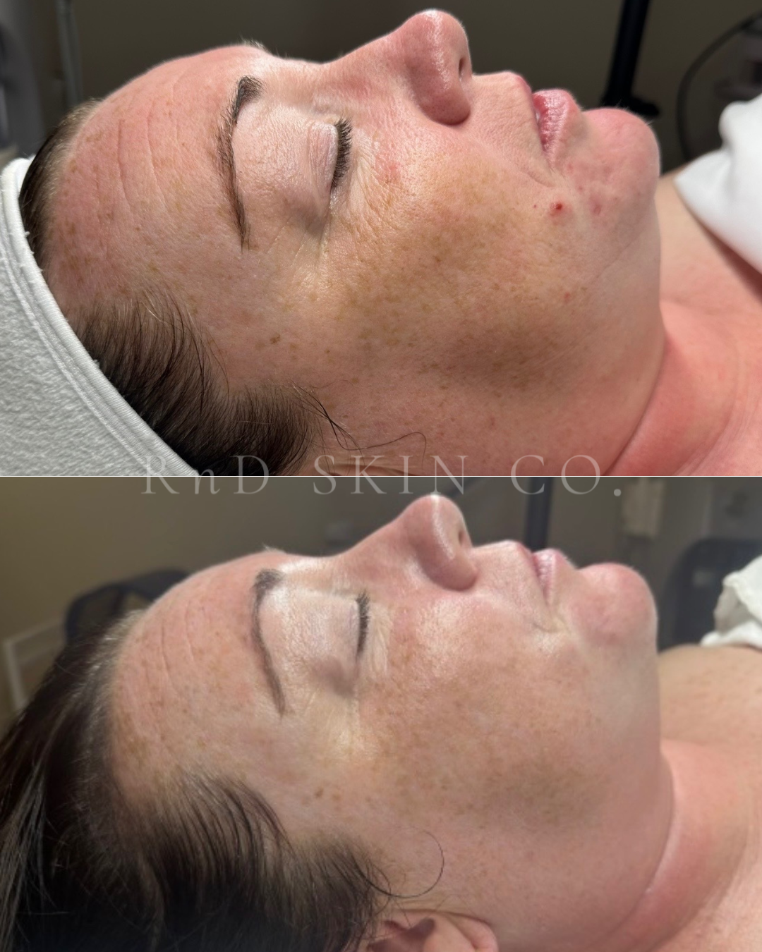 Congestion + Pigmentation + Fine Lines