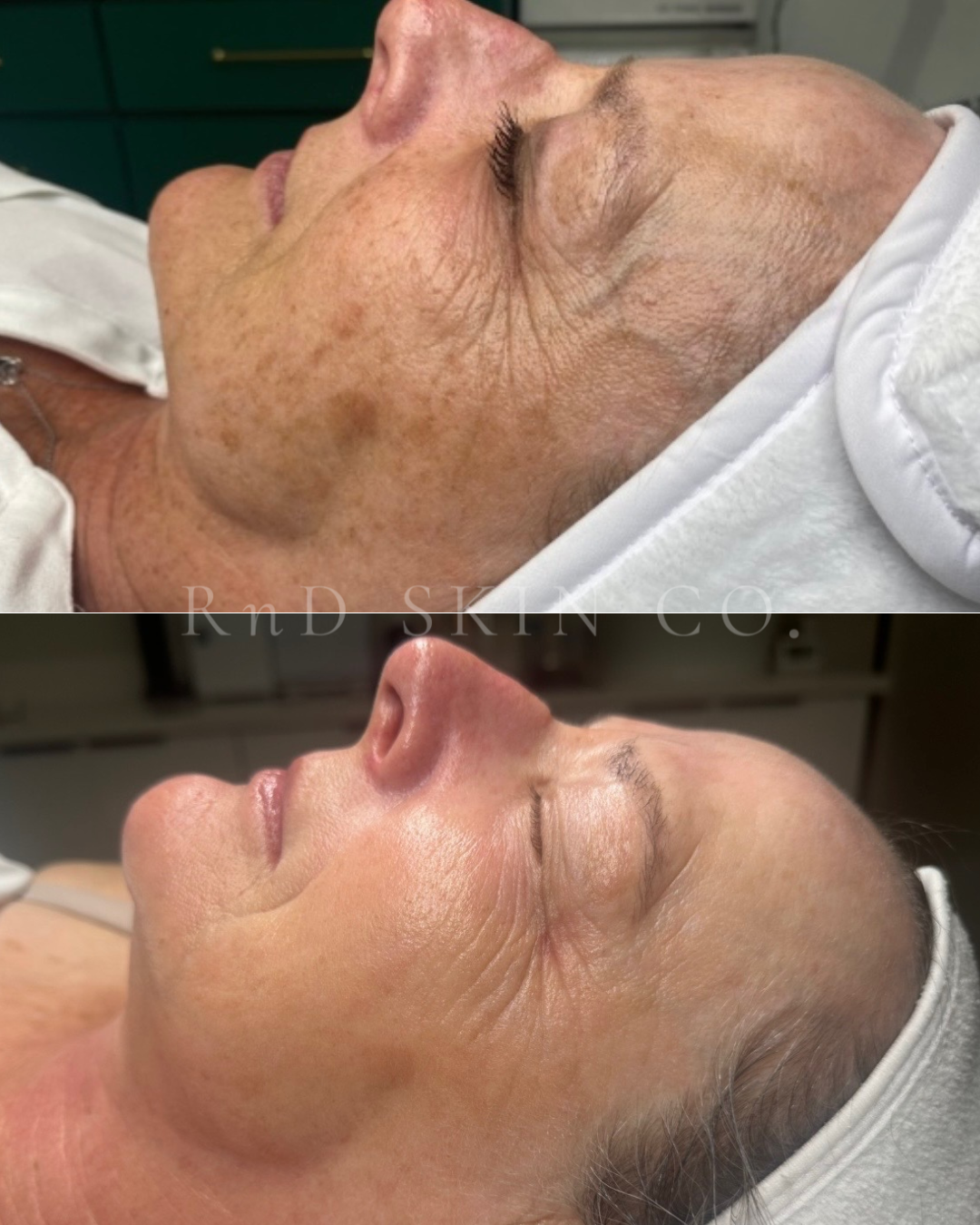 Pigmentation + Fine Lines