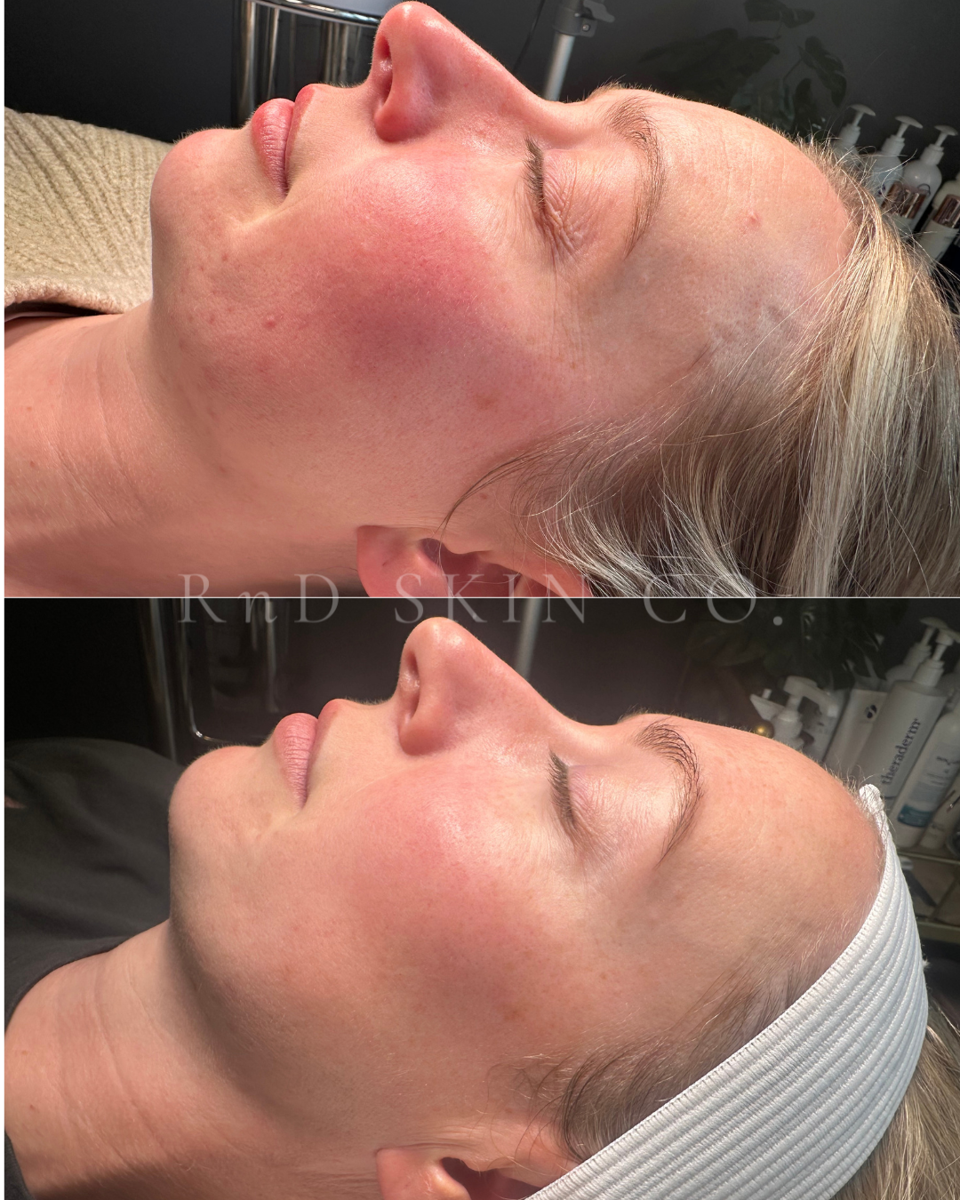 Redness + Congestion + Barrier